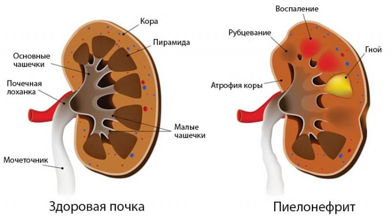 Реферат По Физкультуре Хронический Пиелонефрит