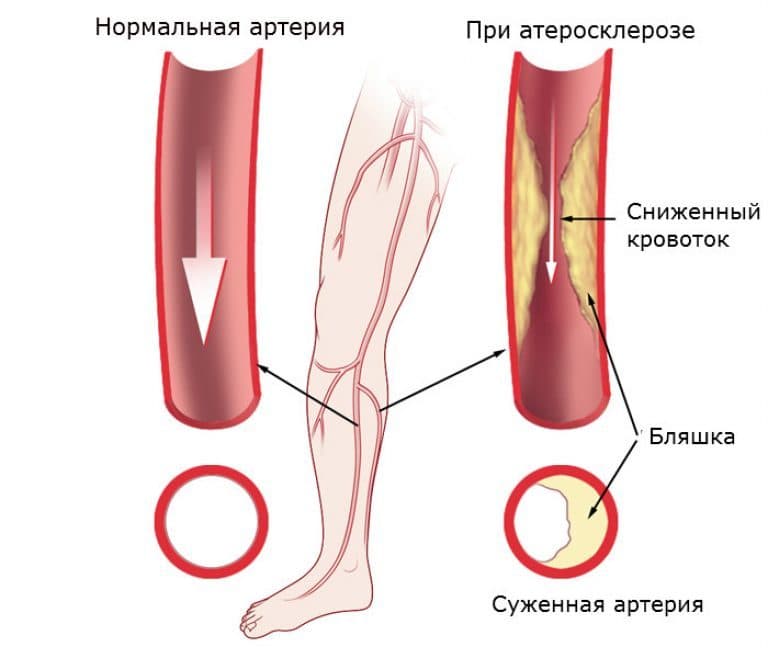 Симптомы артериосклероза