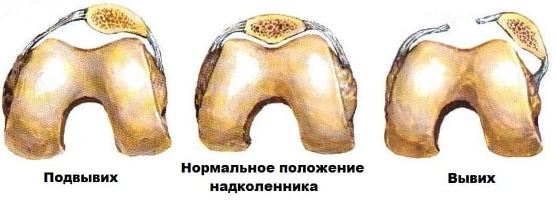 vyvih-nadkolennika-3.jpg
