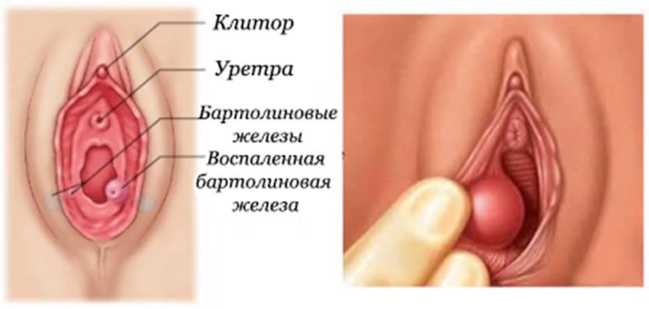 Заболевания бартолиновой железы 1.jpg Заболевания бартолиновой железы 1.jpg
