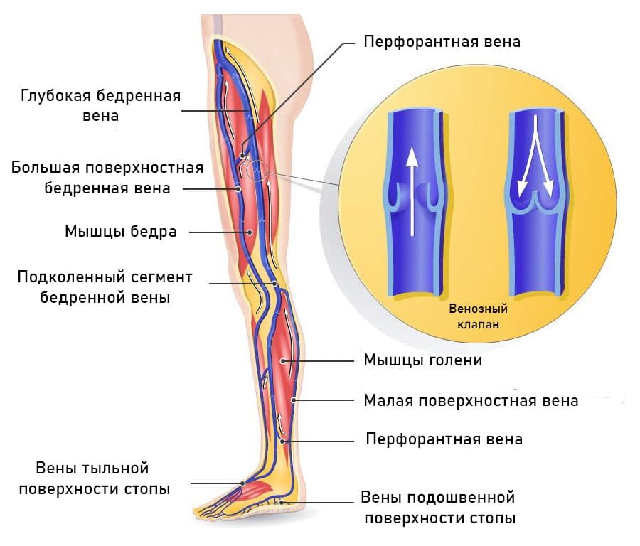 Тромбоз бедренных вен