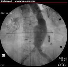Röntgenkontrast-Aortographie 1.jpg