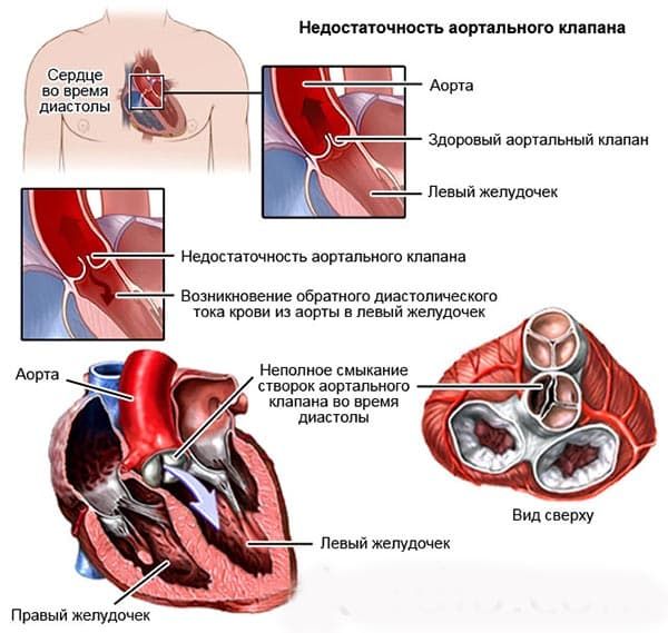Аортальная недостаточность (1).jpg