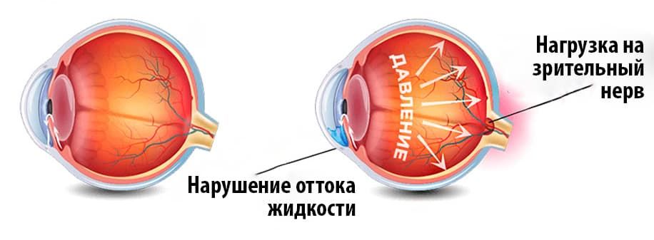 глаукома.jpg