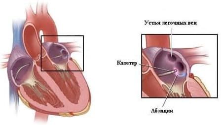 катетерная аблация катетерная аблация