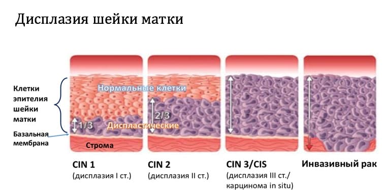 Интраэпителиальное поражение hsil