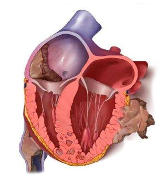 опухоли сердца (3).jpg