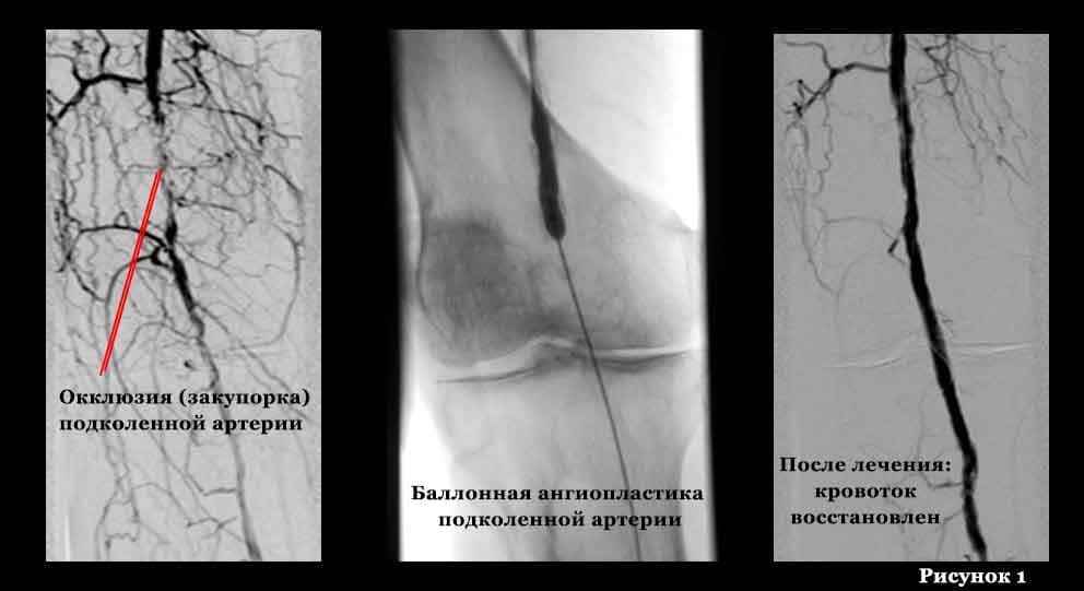 Операция на артерии нижних конечностей. Окклюзионное поражение артерий нижних конечностей. Эмболия подколенной артерии УЗИ. Хроническая окклюзия артерий нижних конечностей. Ангиограмма подвздошных артерий.