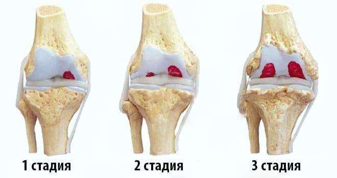 Заболевания по направлению Гонартроз коленного сустава