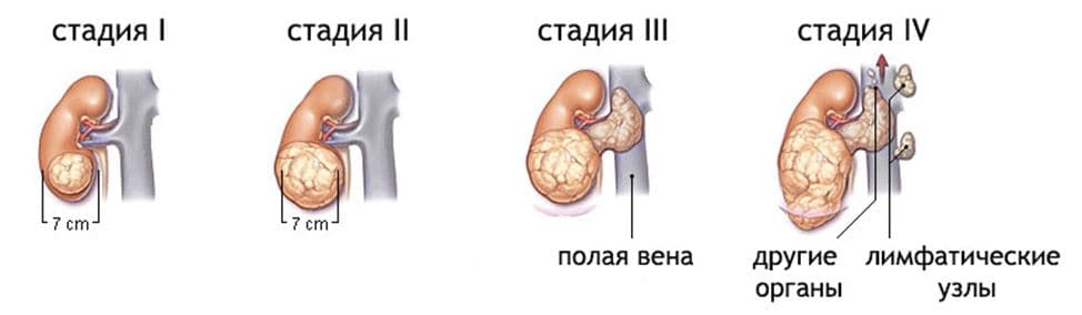 Доклад по теме Опухоли почки