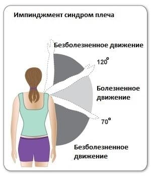 Импинджмент-синдром плечевого сустава2.jpg