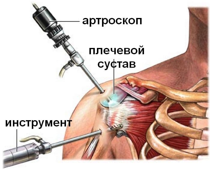 Вывих плеча: какой вред он наносит здоровью