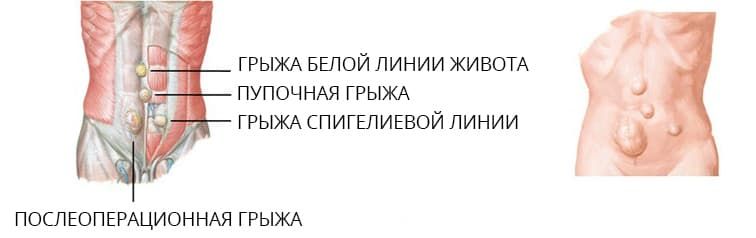 грыжи.jpg