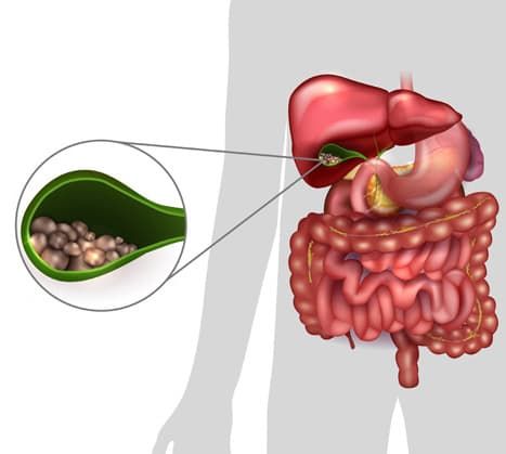 Камни в желчном пузыре лечение спб thumbnail