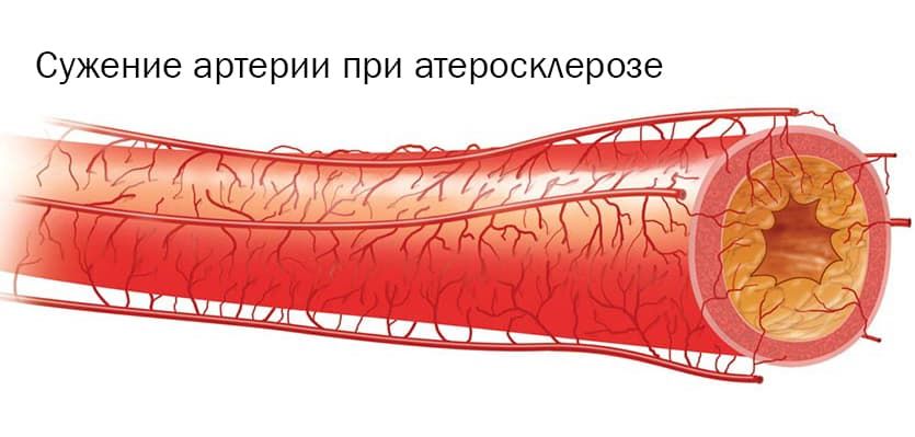 Реферат: Атеросклероз 2