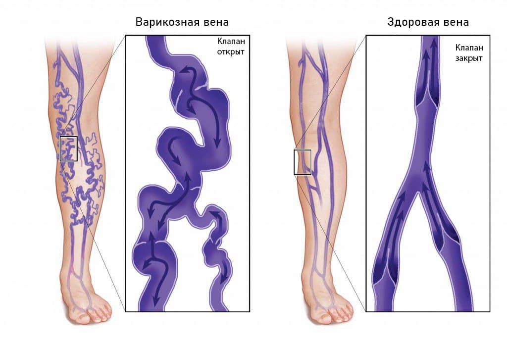 Реферат: Варикозное расширение вен нижних конечностей