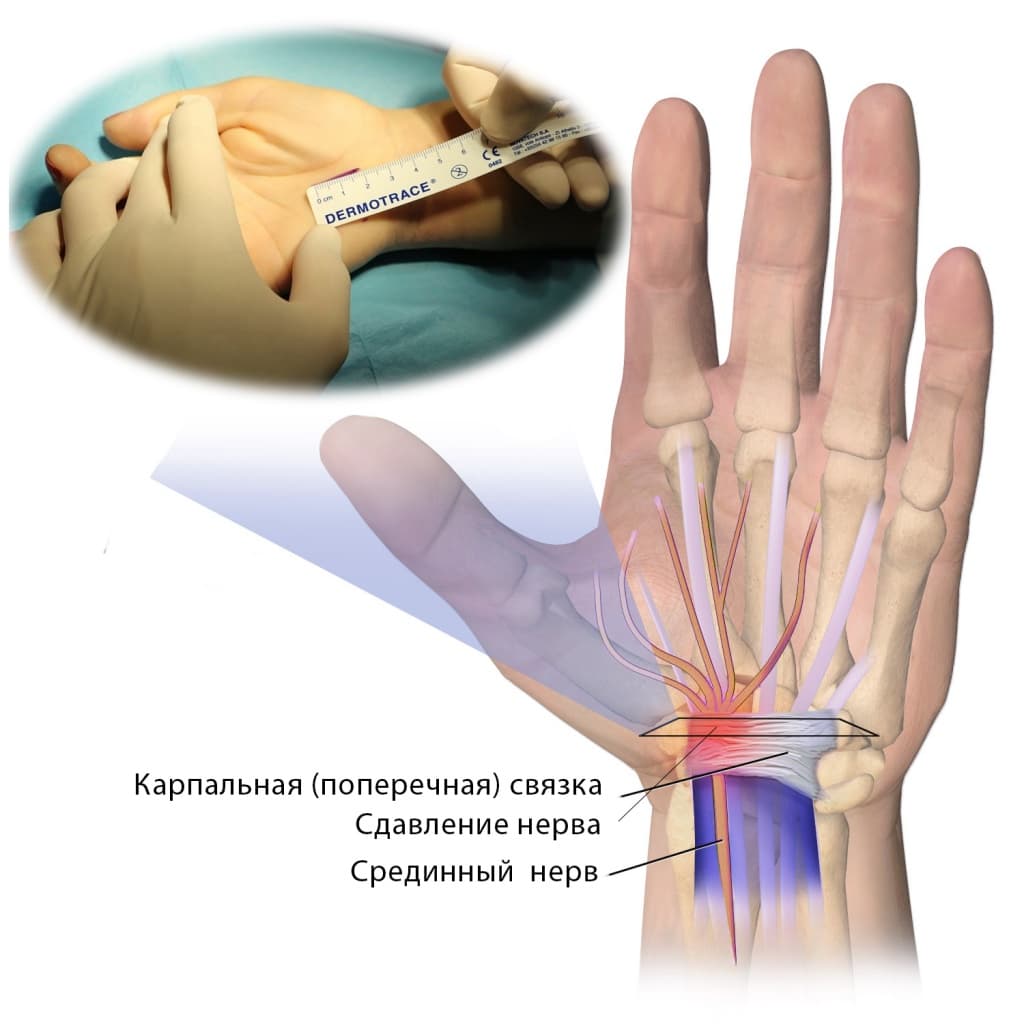 Туннельный синдром врачи. Синдром карпального клапана кисти. Карпальный синдром лучезапястного сустава. Туннельный синдром запястья кисти. Карпальный туннельный.