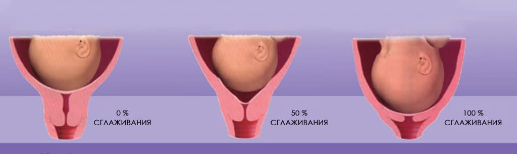 Истмико-цервикальная недостаточность: диагностика и лечение в СПб, цена -записаться к гинекологу