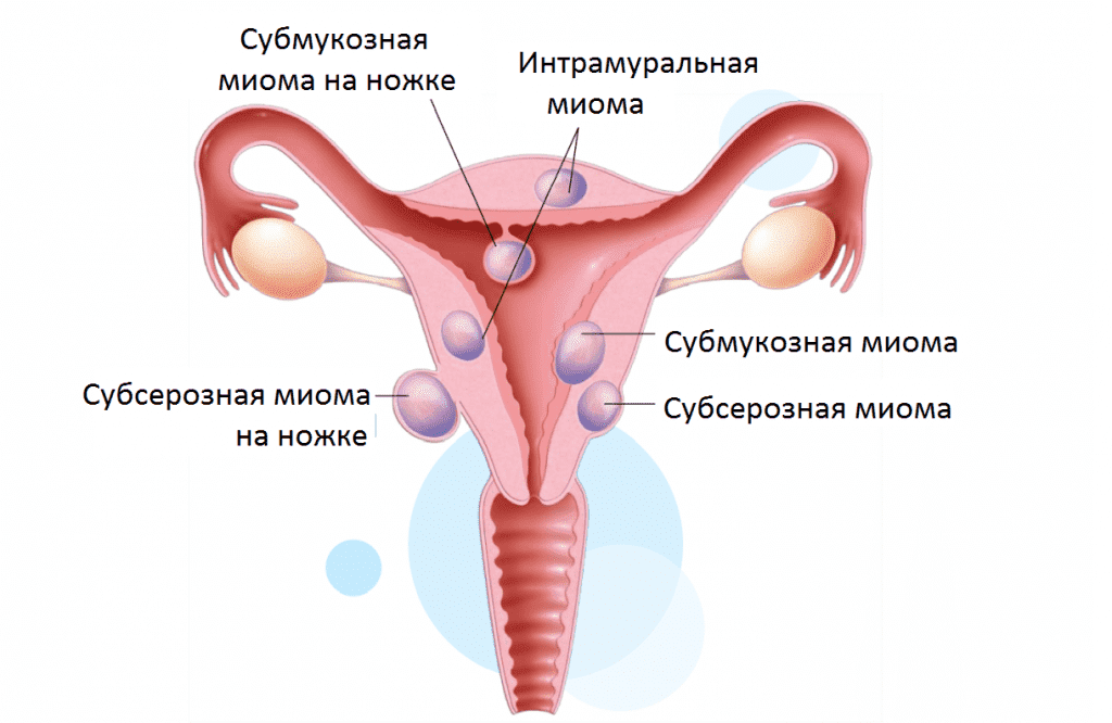 Классификация миомы матки по figo слаж