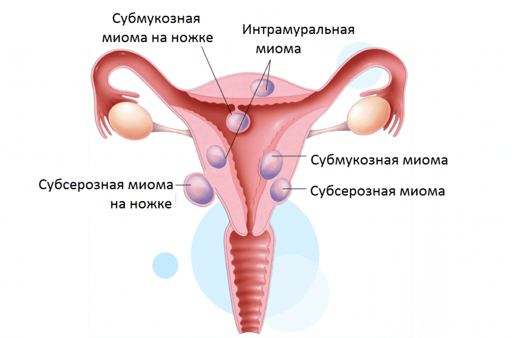 Как Выглядит Миома Фото