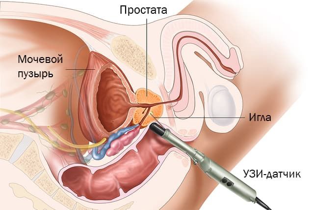 узи предстательной железы.jpg