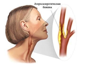 Где Находятся Брахиоцефальные Артерии У Человека Фото