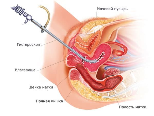 Контрольная работа по теме Лапароскопия в гинекологии