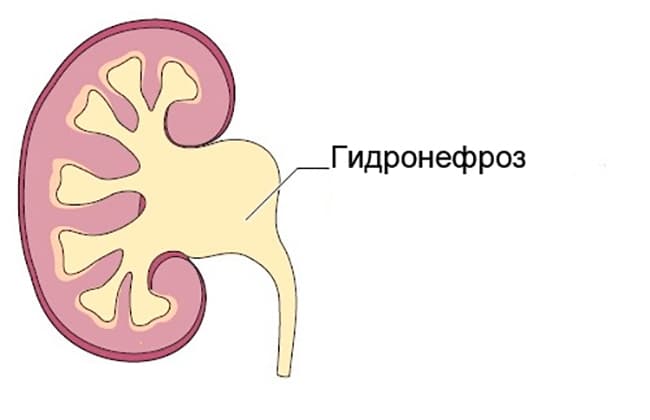 гидронефроз3.jpg