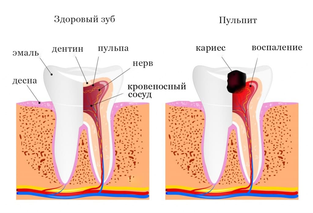 пульпит.jpg