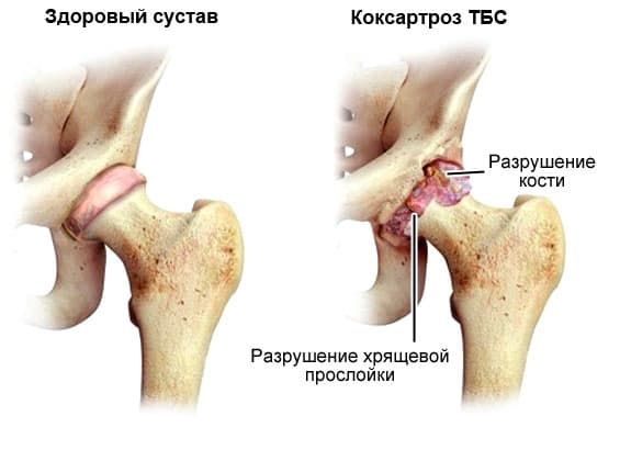 Реферат: Симптомы дисплазии тазобедренных суставов