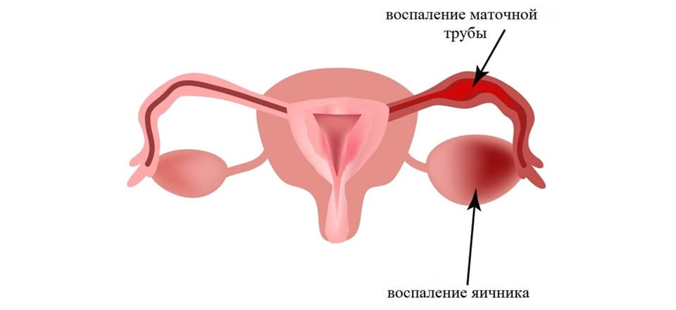 Воспаление женских половых органов
