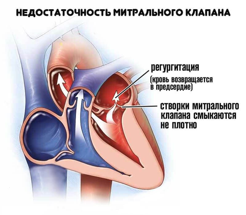 Реферат: Пролапс митрального клапана 2