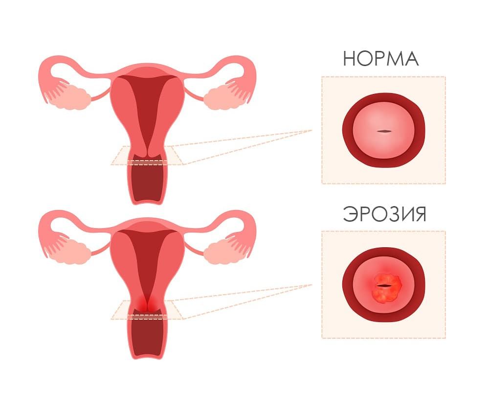 Реферат: Эрозии шейки матки