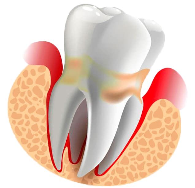 periodontit01.jpg