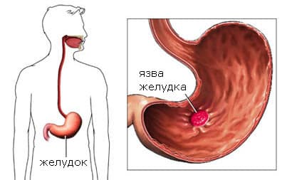 yazva-zheludka.jpg