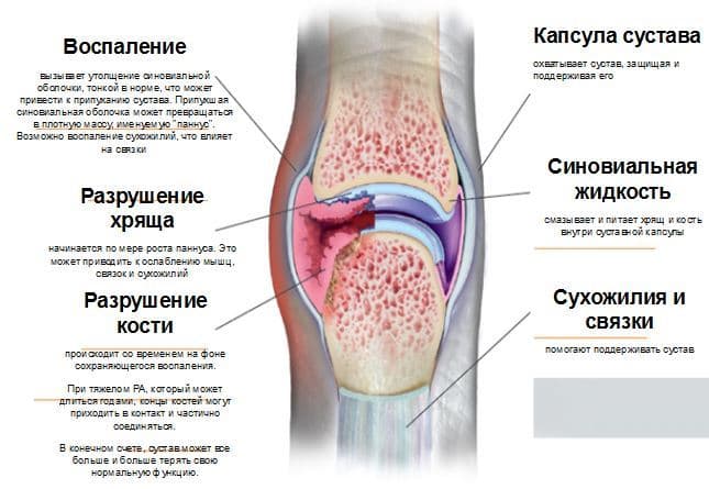 Реферат: Псориатический артрит этиология и лечение