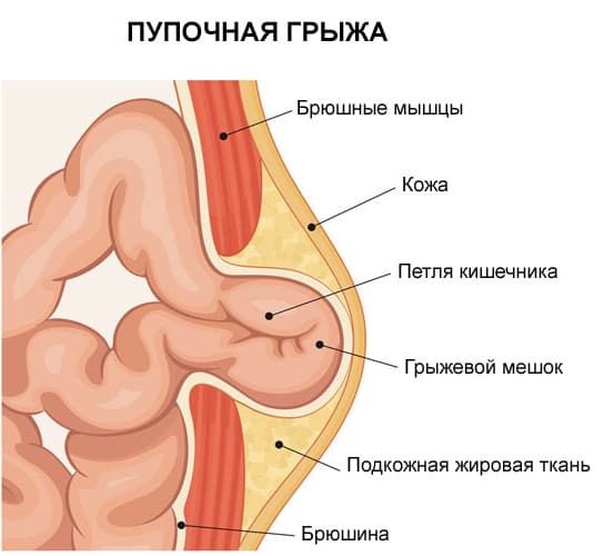 Грыжа Под Фото