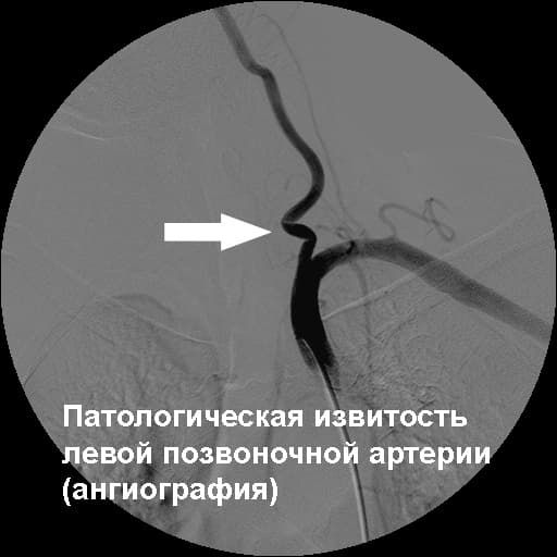 патологическая извитость.jpg патологическая извитость.jpg