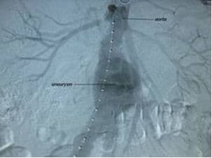 Röntgenkontrast-Aortographie 2.jpg