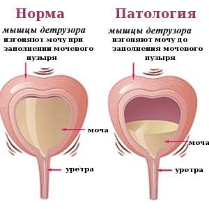 Мочевой Пузырь Фото У Женщин