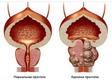 Аденома предстательной железы