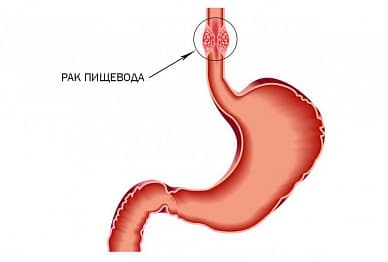 Рак пищевода