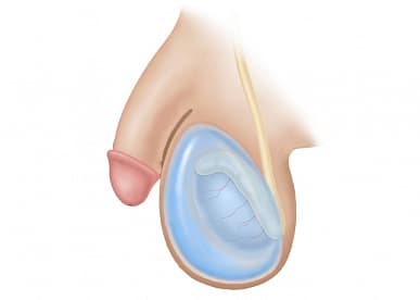 Водянка оболочек яичка