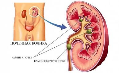 Почечная колика